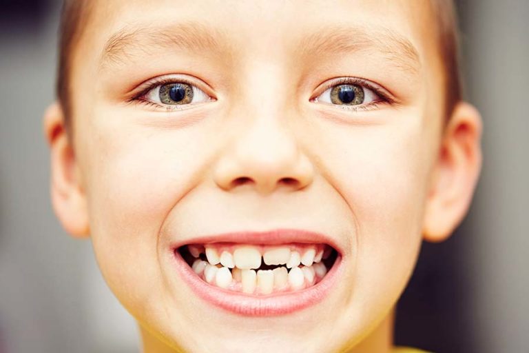 “Chalky Teeth” Enamel Hypomineralisation